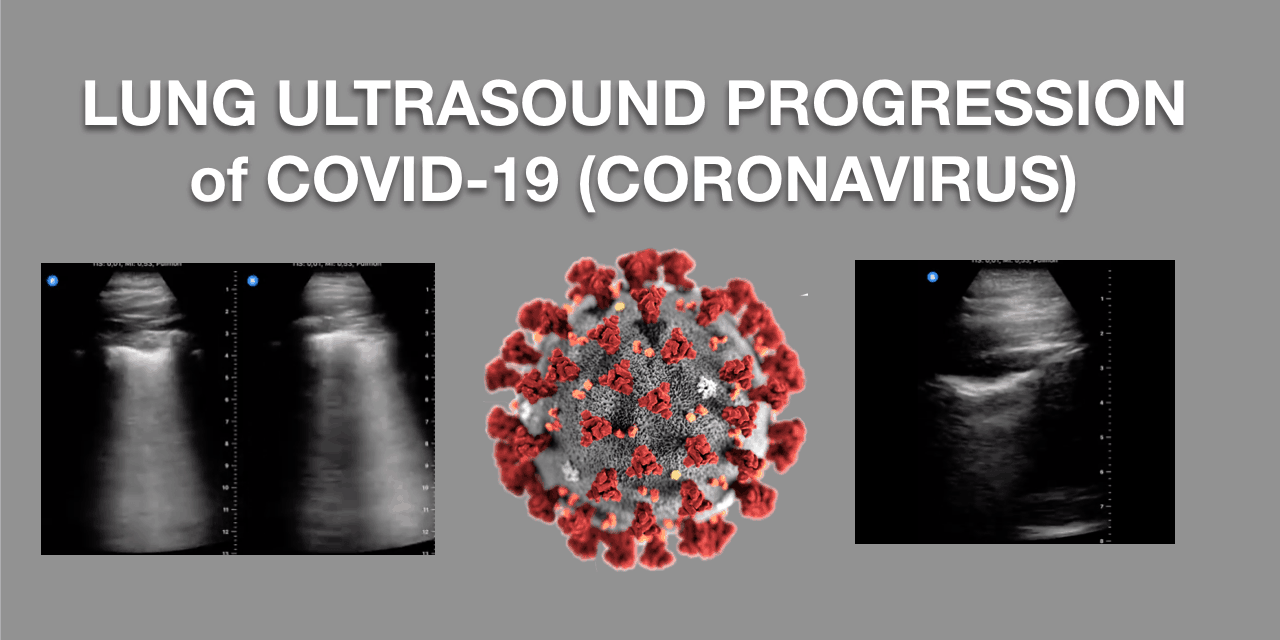 lung ultrasound covid-19 coronavirus