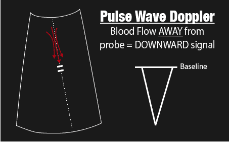Pulse Wave Doppler AWAY from Probe