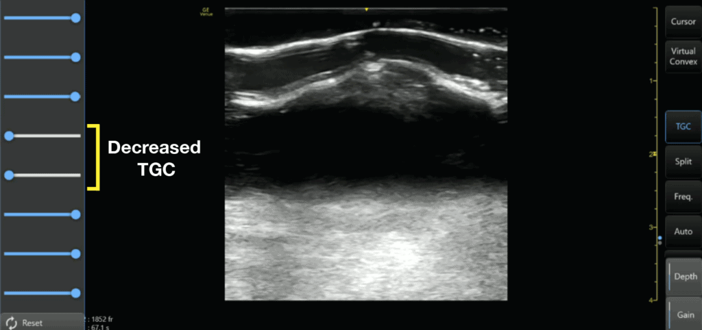 Decrease TGC in Middle of Ultrasound Image