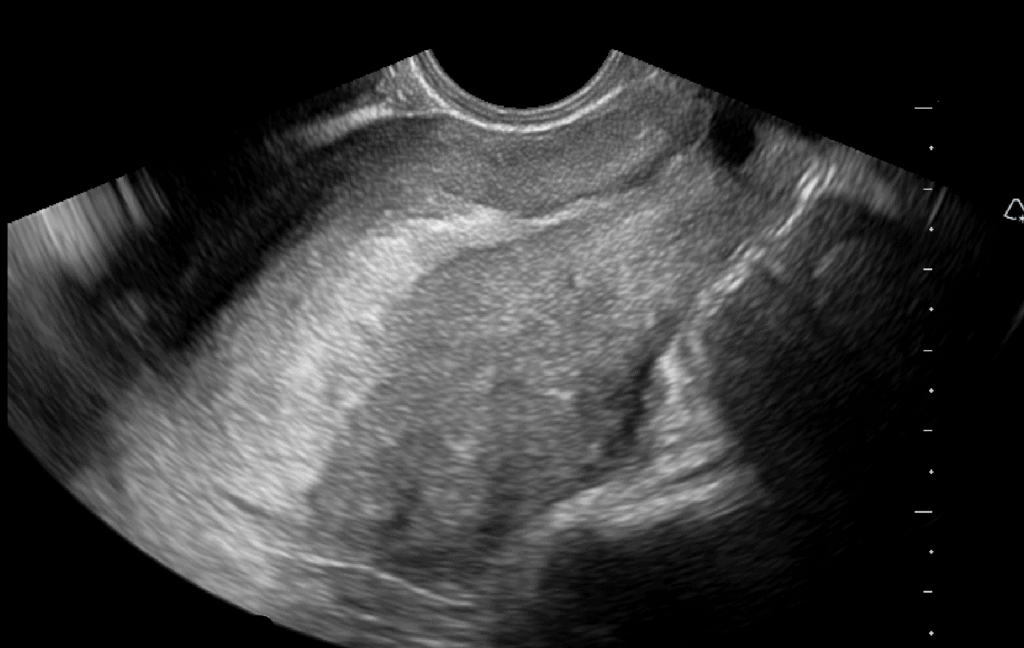 Endocavitary Probe - Pelvic Ultrasound