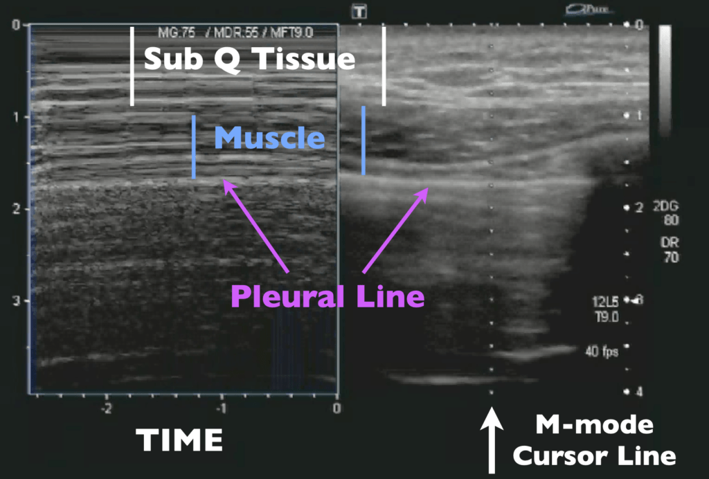 M-mode Lung Sliding - Images Labeled