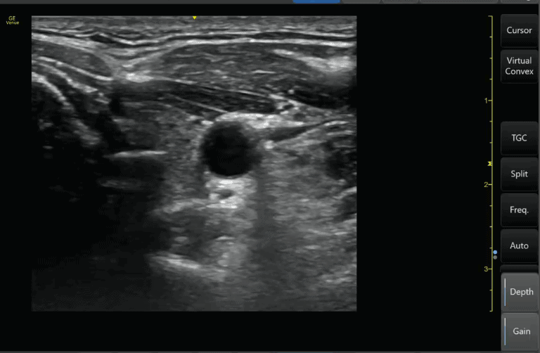 Optimal gain Ultrasound Image