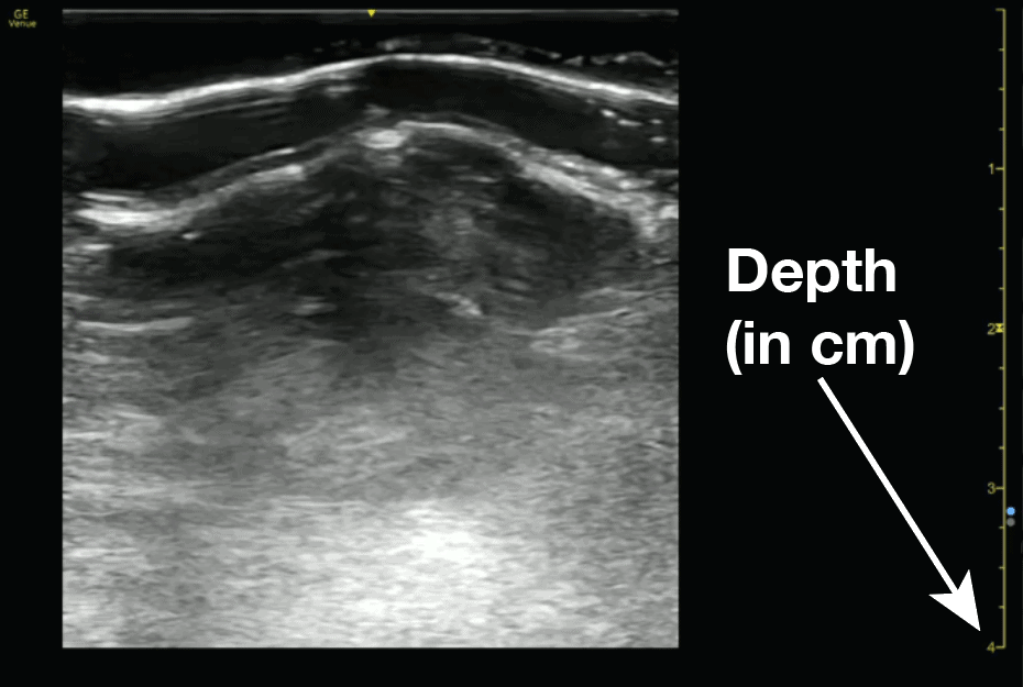 Ultrasound Depth Marker