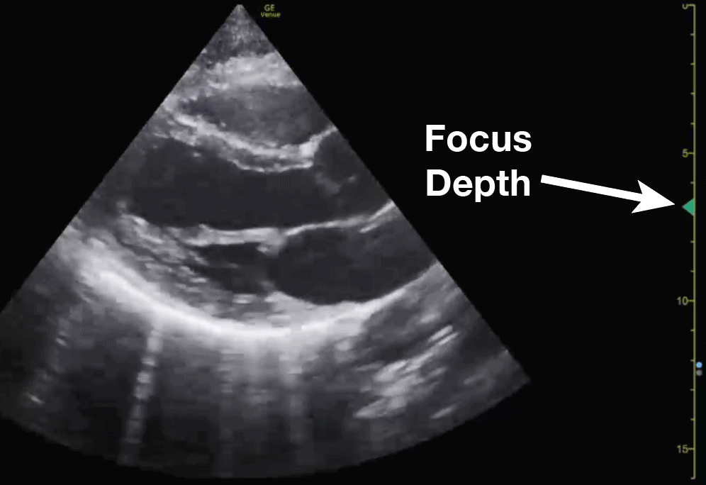 Ultrasound Focus Depth