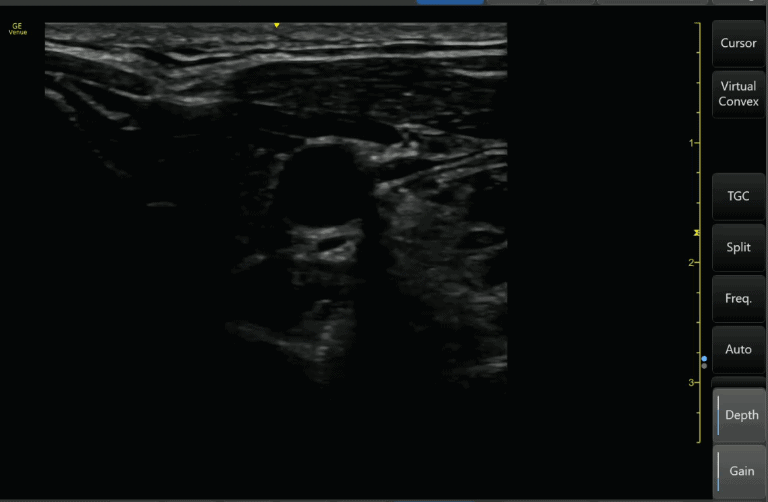 Undergained Ultrasound Image