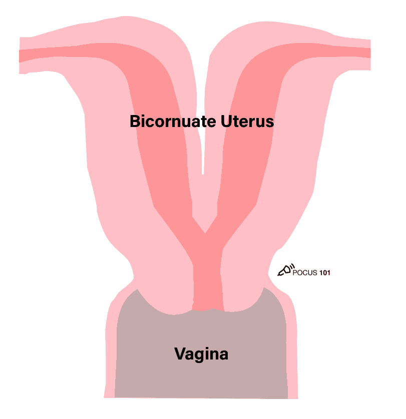 Bicornuate Uterus Illustration - Pelvic Ultrasound Gynecology