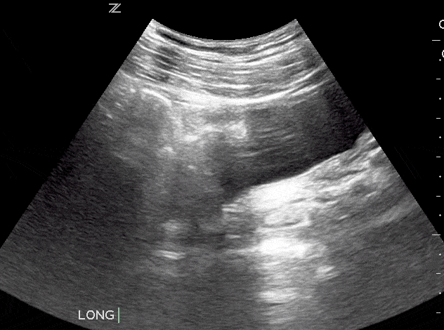 Bladder Diverticulum Ultrasound