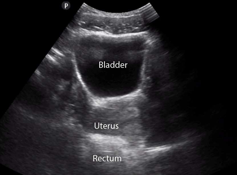 Bladder-Ultrasound-Female-Transverse