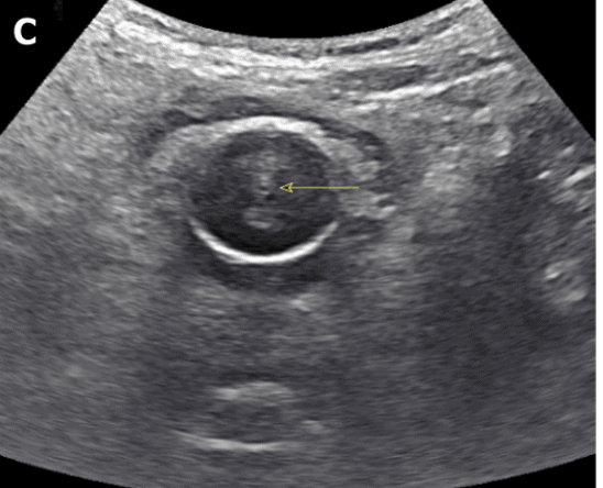 Bladder Ultrasound Normal Functioning Urethral Foley Catheter