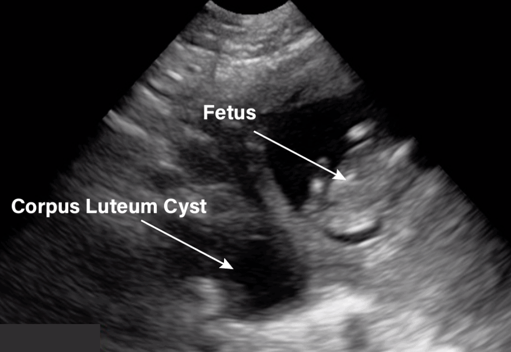 Corpus Luteum Cyst Pelvic OB Gynecology Ultrasound - Labeled