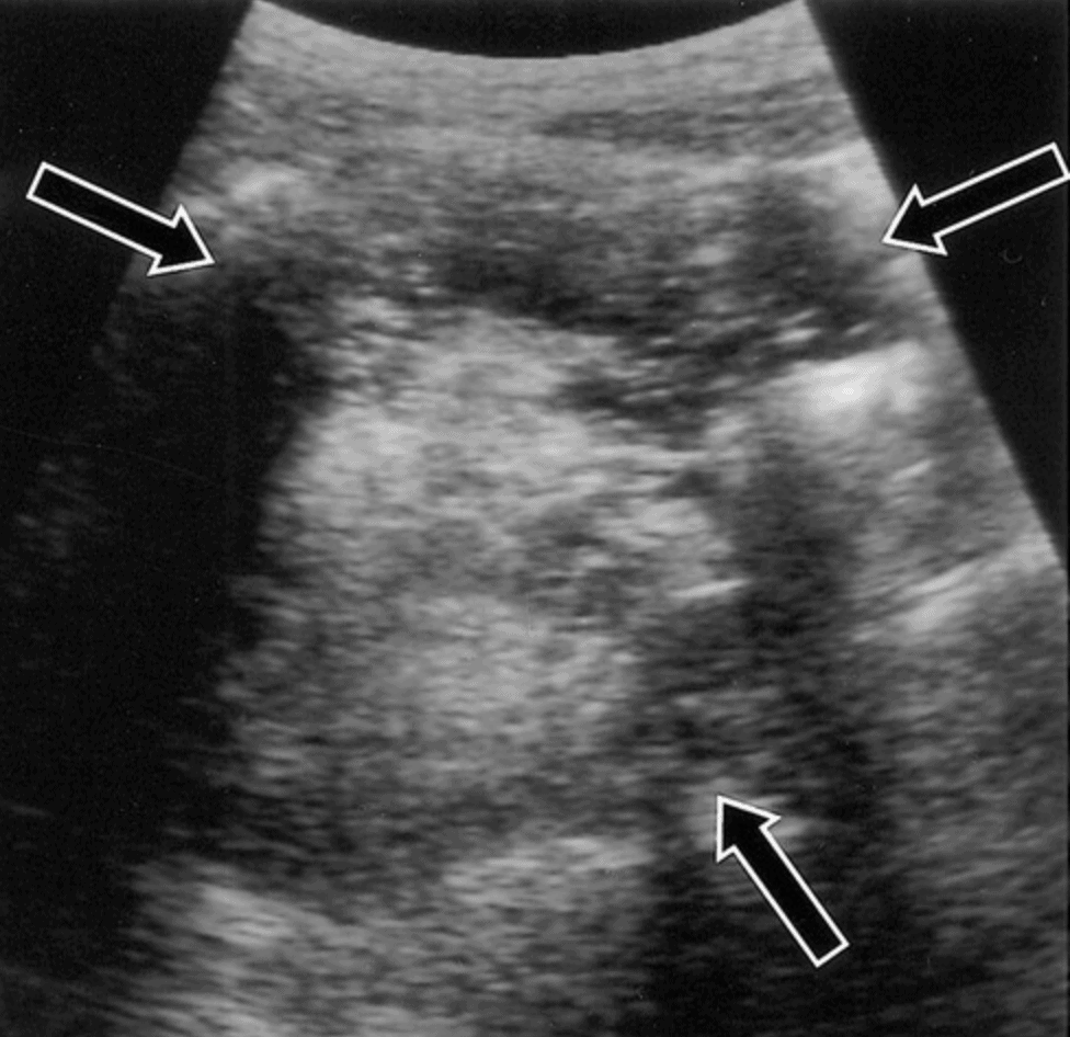 Dermoid Cyst Teratoma Diffuse Echogenicity Pelvic Ultrasound