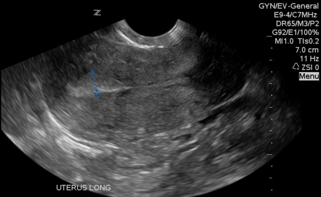 Endometrial Hyperplasia and measurement pelvic gynecology ultrasound