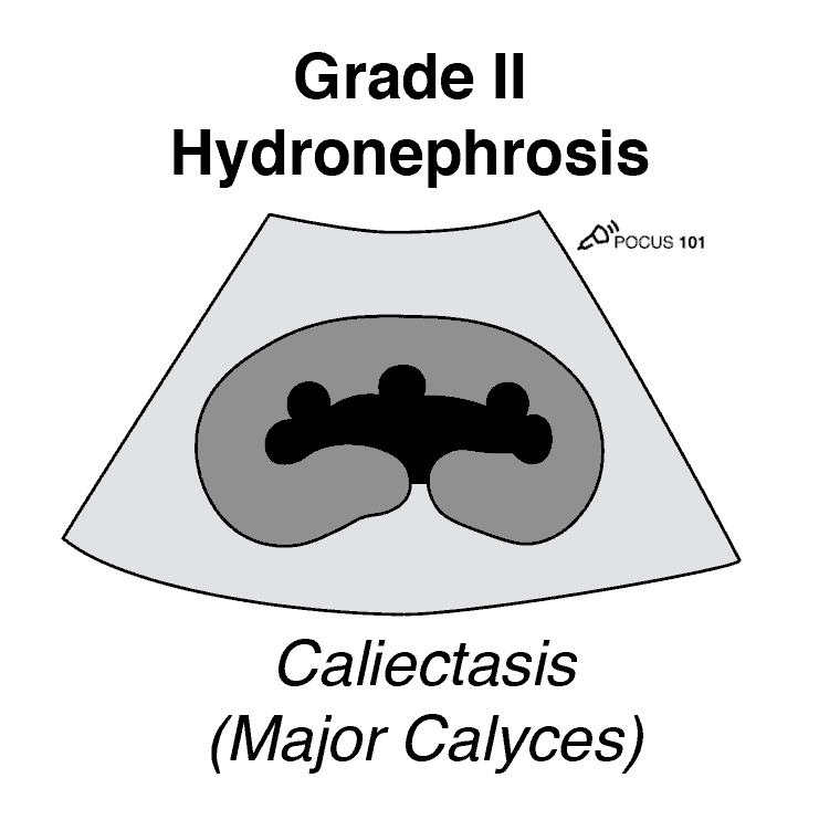 Grade 2 Hydronephrosis Caliectasis Renal Ultrasound Mild