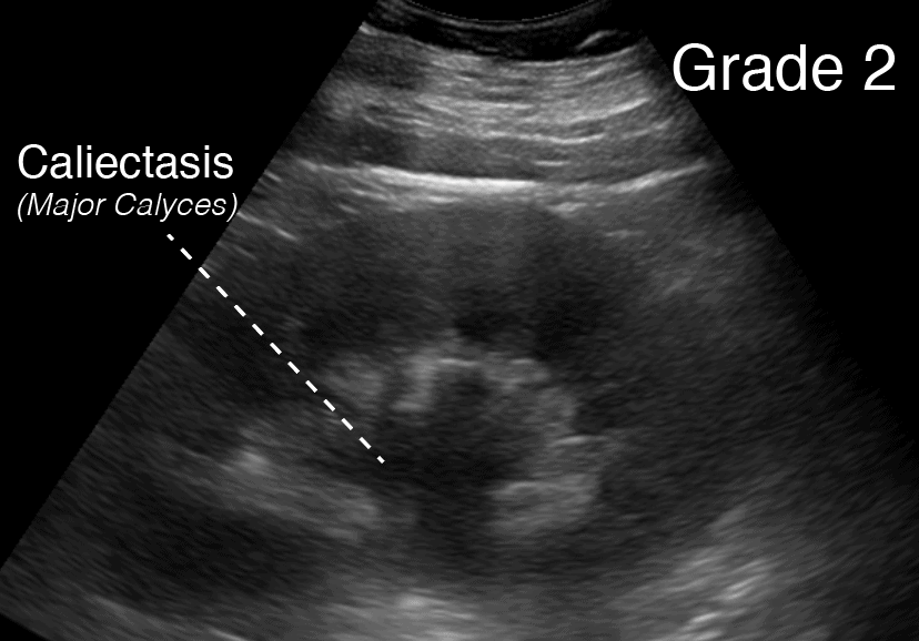 Grade 2 Hydronephrosis Renal Ultrasound - Labeled