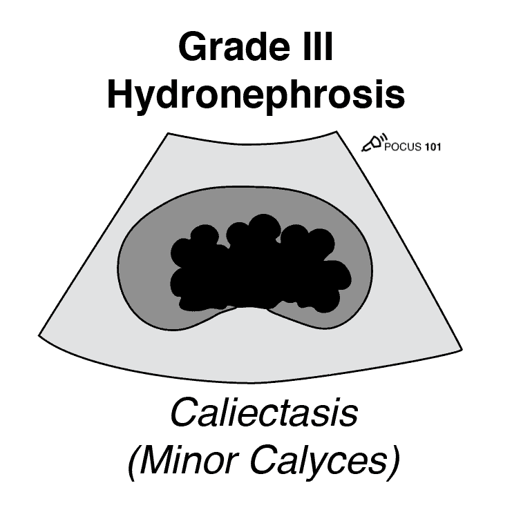 Grade 3 Hydronephrosis Caliectasis Renal Ultrasound Moderate