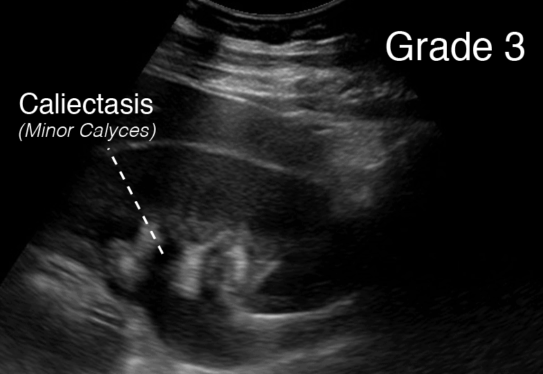 Grade 3 Hydronephrosis Renal Ultrasound - Labeled