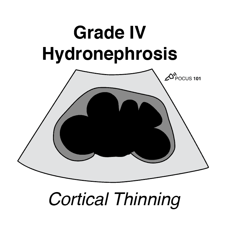 Grade 4 Hydronephrosis Cortical Thinning Renal Ultrasound Severe