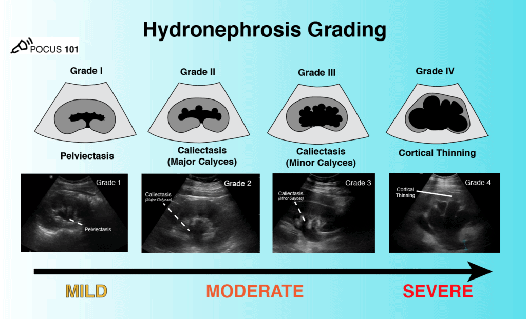 Hydronephrosis Grading Pocket Card PDF Image