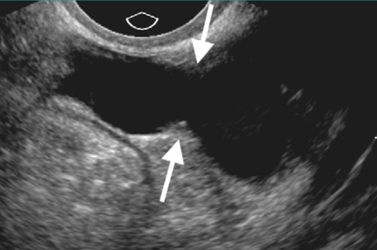 Hydrosalpinx Pelvic Ultrasound Waist Sign