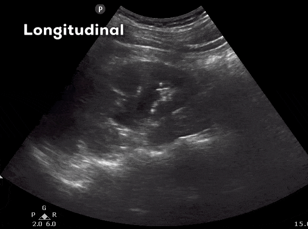 Kidney Renal Ultrasound Longitudinal to Transverse View