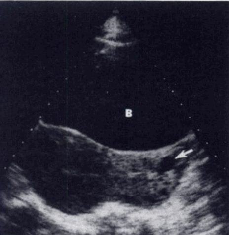 Nabothian Cyst - Pelvic Gynecology Ultrasound