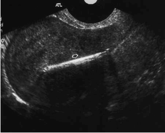 Normal Intrauterine Device Placement IUD Pelvic Ultrasound