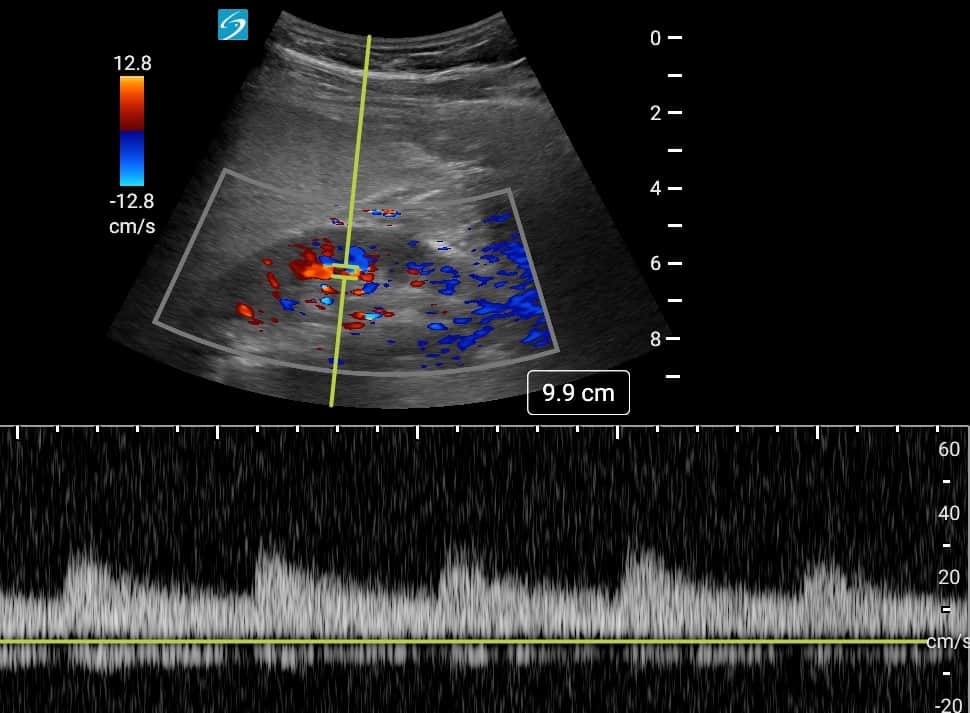 Normal Renal Doppler - Resistive Index and Venous - No measurement done