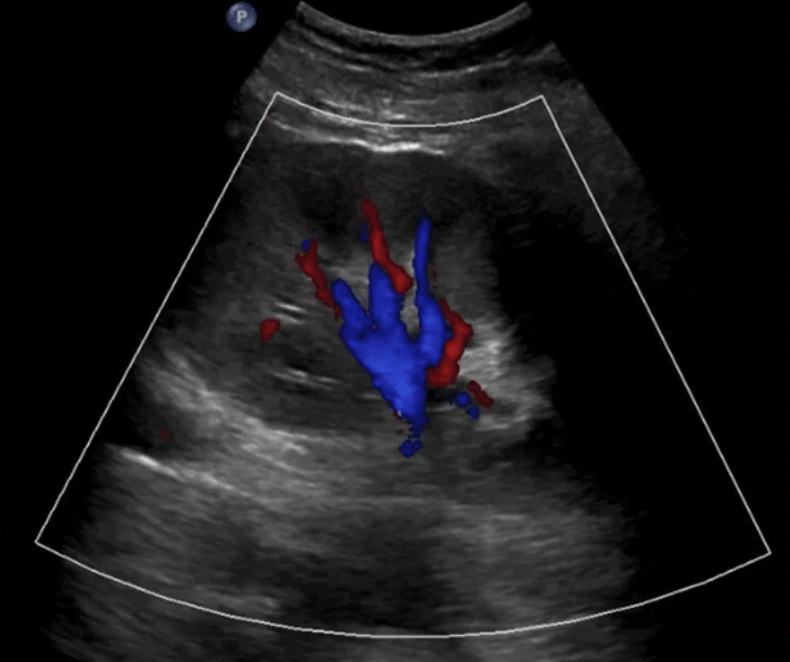 Prominent Kidney Hilar Vasculature - Renal Ultrasound - Color Doppler