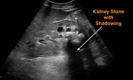 Renal Ultrasound Intraparenchymal Kidney Stone with Acoustic Shadowing
