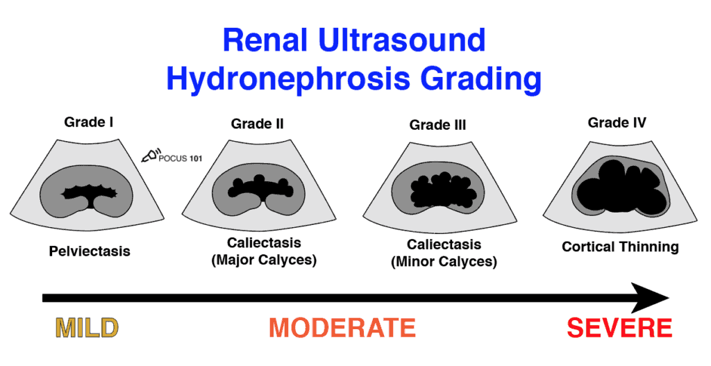 Renal Ultrasound Kidney Hydronephrosis Grading