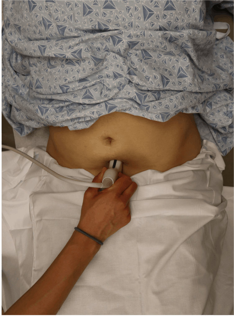 Sagittal-Uterus-Probe-Position Pelvic Ultrasound