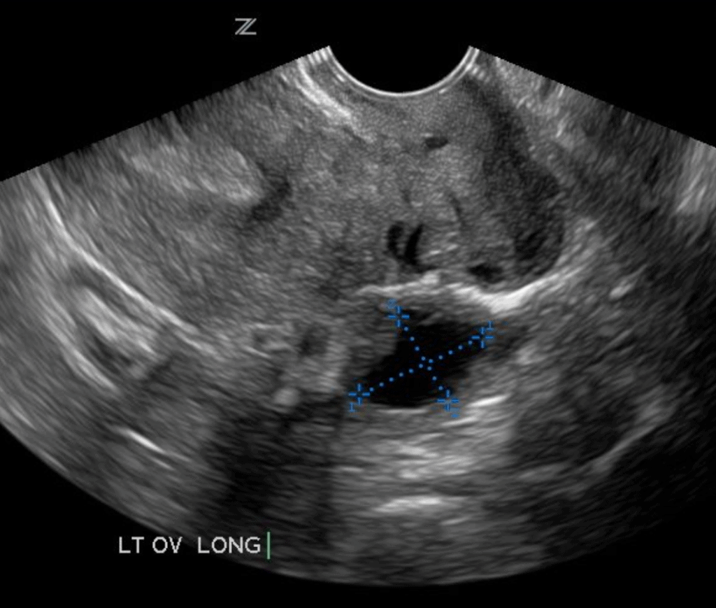 Simple ovarian cyst pelvic ultrasound