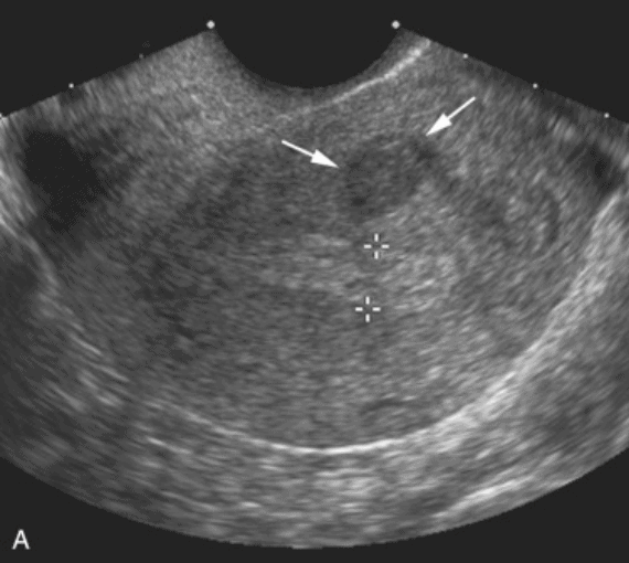 Submucosal Intramural Fibroid Pelvic Ultrasound Gynecology