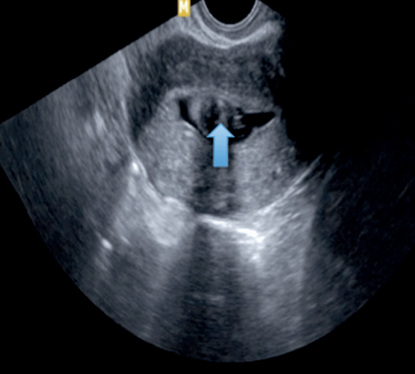 Submucosal Leiomyoma Fibroid Pelvic Ultrasound Gynecology
