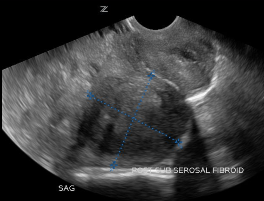 Subserosal Leiomyoma Fibroid Pelvic Ultrasound Gynecology