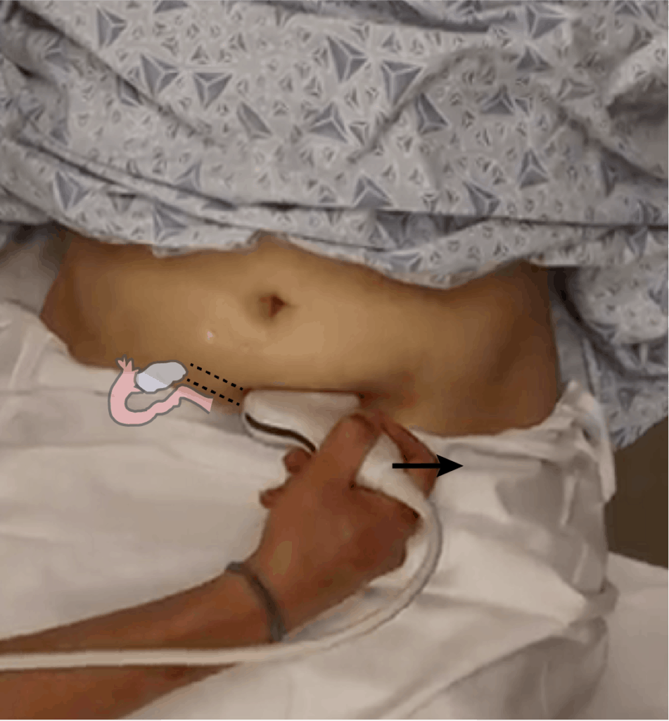 Transabdominal Pelvic Ultrasound Ovary Probe Positioning