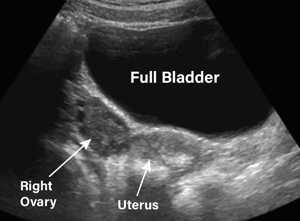 Transabominal Pelvic ultrasound Ovary