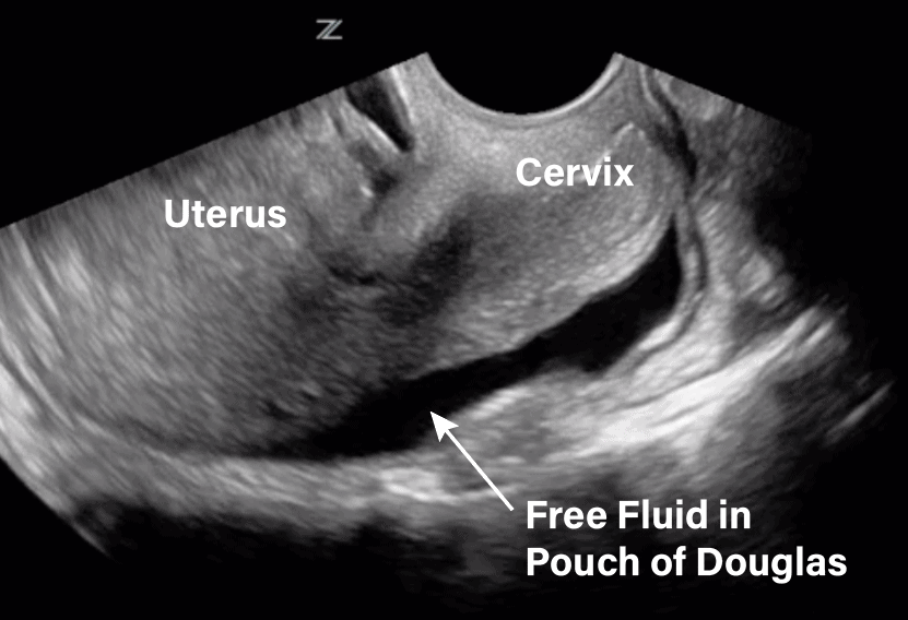 Transvaginal Ultrasound Free Fluid in Pouch of Douglas Sagittal View