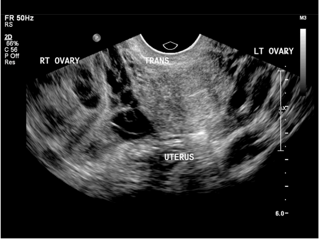 Tubo-ovarian abscess pelvic ultrasound