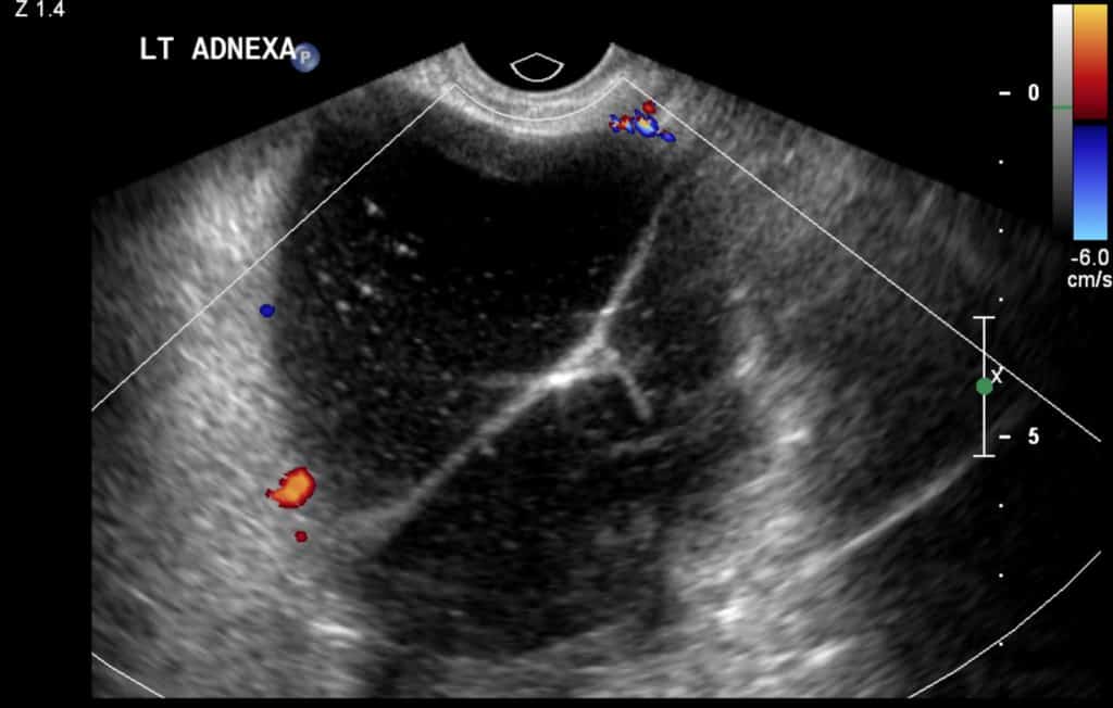 mucinous cystadenoma pelvic ultrasound gynecologymucinous cystadenoma pelvic ultrasound gynecology