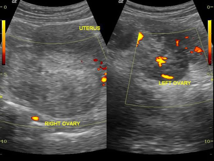 ovarian-torsion pelvic ultrasound gynecology Power Doppler