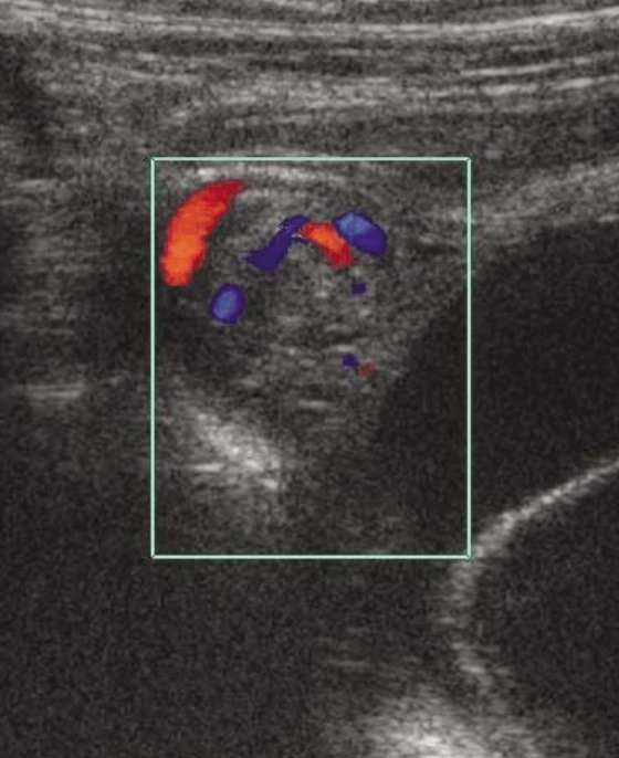 ovarian-torsion pelvic ultrasound gynecology Whirlpool Sign