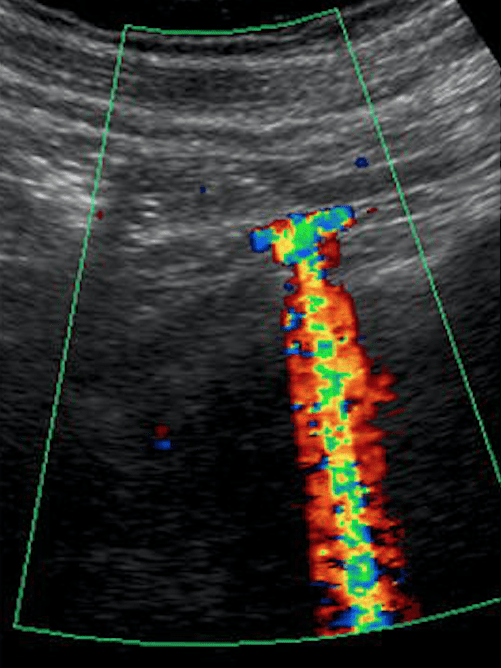 twinkling twinkle artifact renal kidney ultrasound - Zoomed