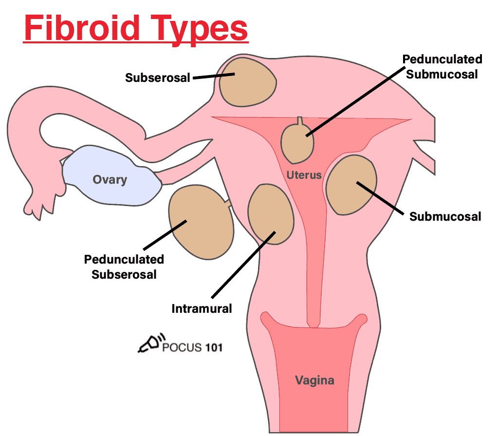 uterine uterus fibroid types anatomy pelvic ultrasound