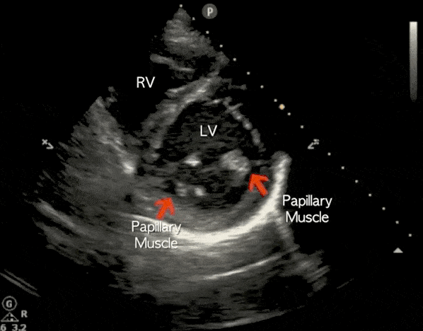 Cardiac Ultrasound Echocardiography Parasternal Short Axis View PSSA PSAX Mid Papillary Video