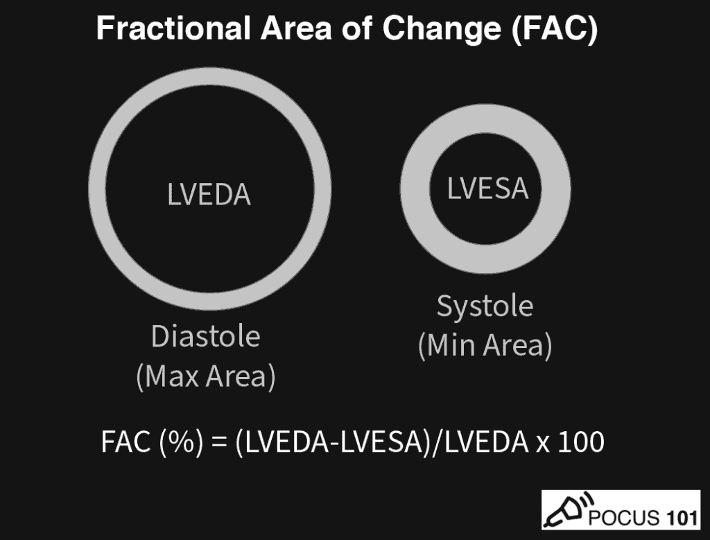 Fractional Area of Change FAC Illustration Cardiac Ultrasound Echocardiography