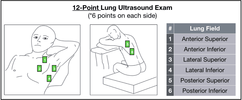 12-point lung ultrasound exam figure