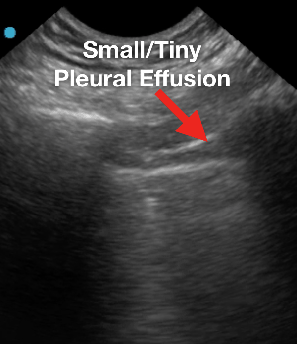 Small Tiny Pleural Effusions