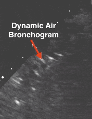 Dynamic Air Bronchogram