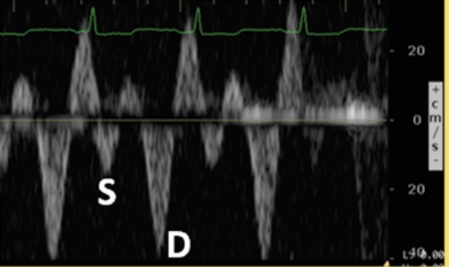 Hepatic Vein Doppler Grade 1